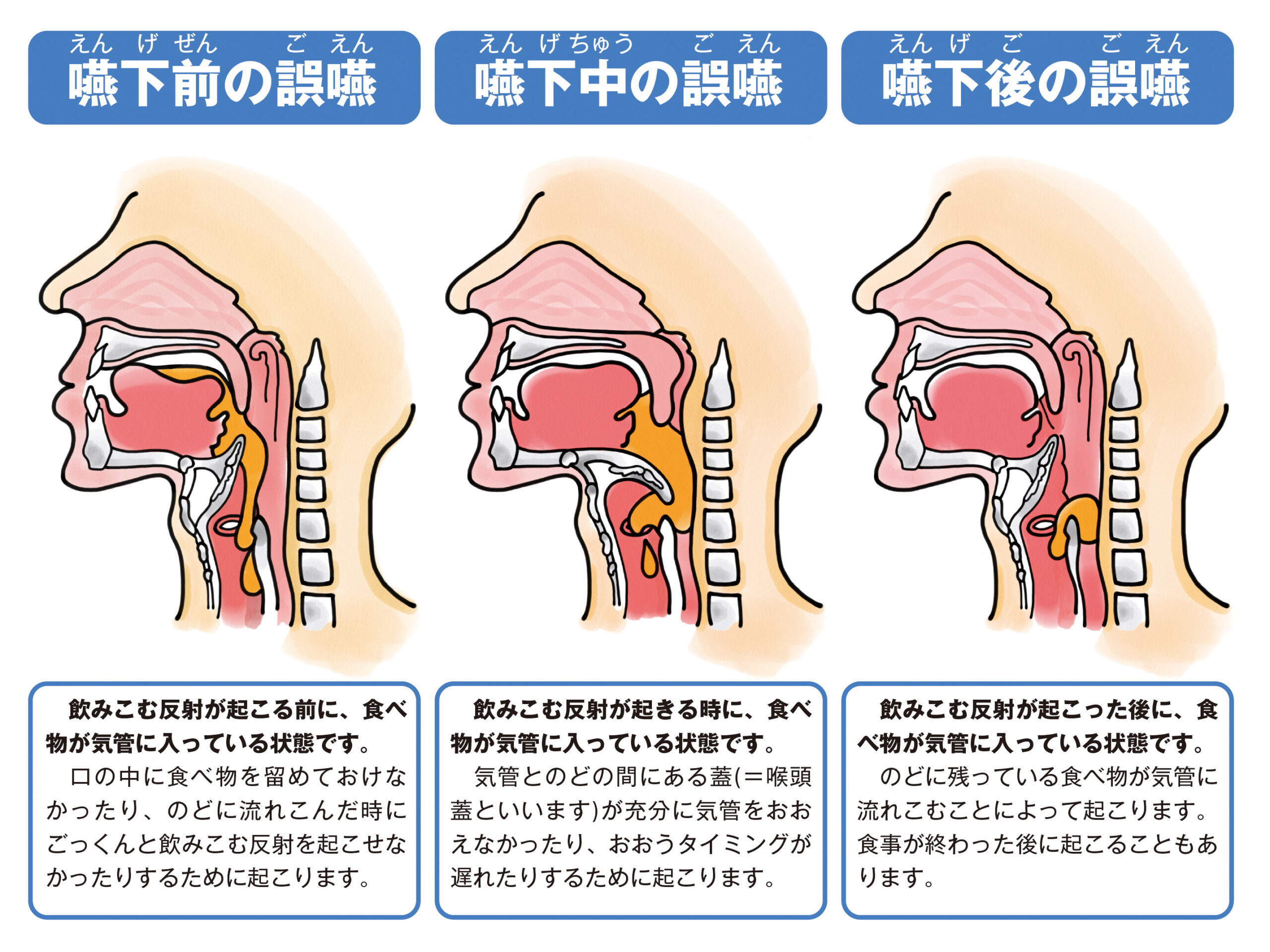 3つの誤嚥の種類のイラスト お役立ち資料 リハビリのイラスト無料 えすてぃちゃん